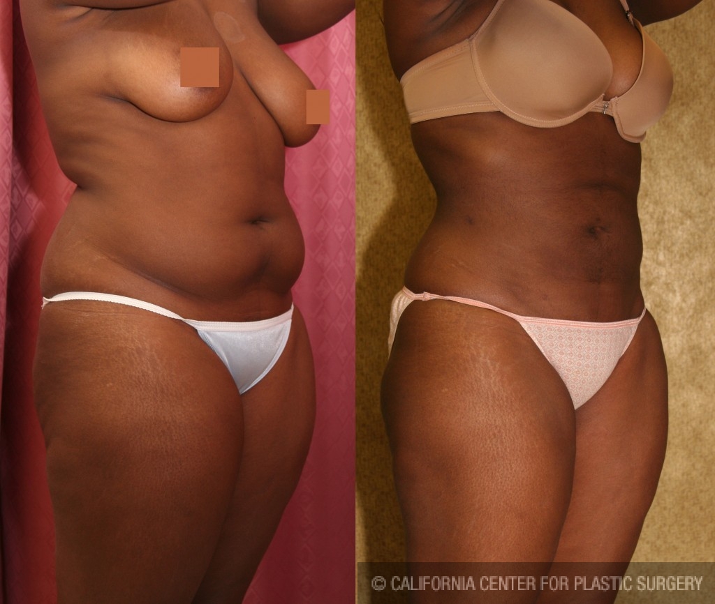 Smartlipo Flanks Liposuction for Women - Before & After Photos