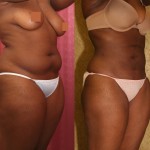 Liposuction Abdomen Medium Before & After Patient #5561