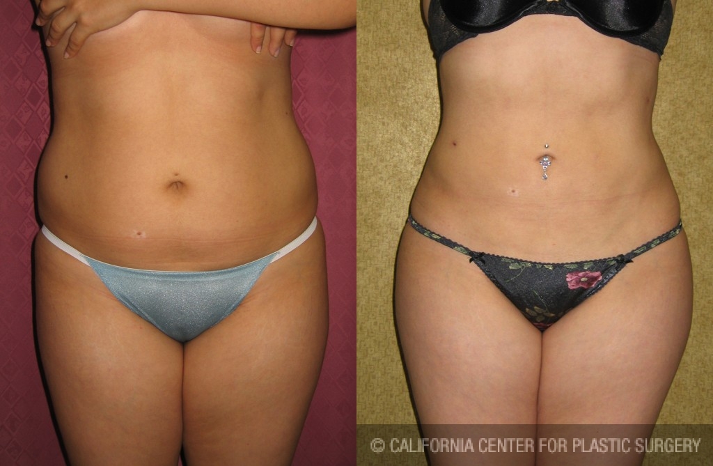 Liposuction Abdomen Medium Before & After Patient #5527