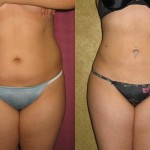 Liposuction Abdomen Medium Before & After Patient #5527