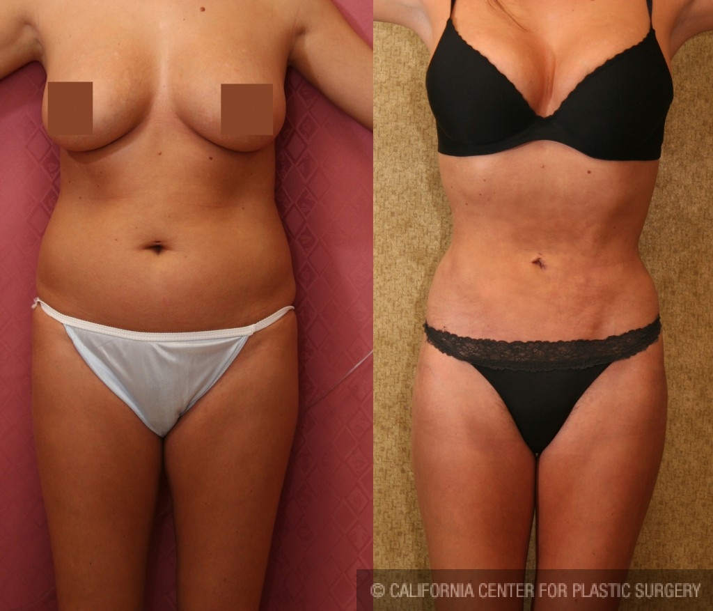 Liposuction Abdomen Medium Before & After Patient #5538