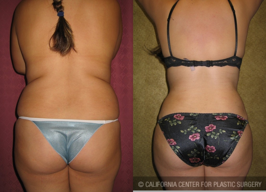 Liposuction Abdomen Medium Before & After Patient #5527