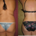 Liposuction Abdomen Medium Before & After Patient #5527