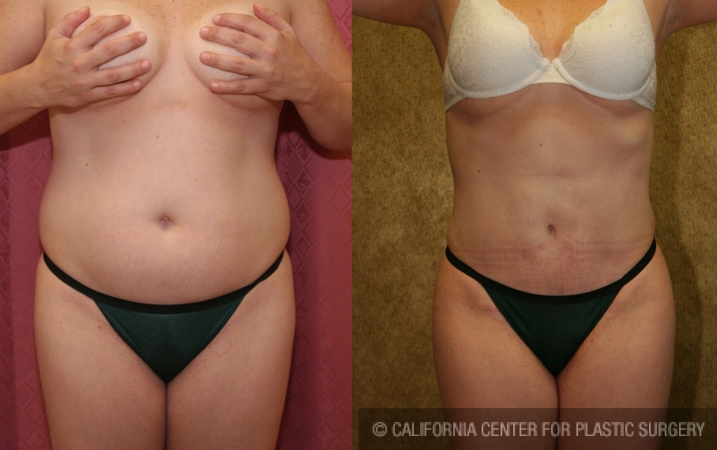 Liposuction Abdomen Medium Before & After Patient #5532