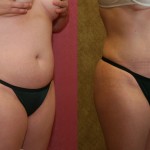 Liposuction Abdomen Medium Before & After Patient #5532