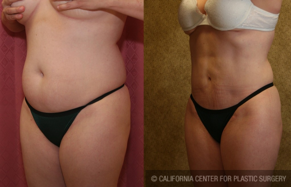 Liposuction Abdomen Medium Before & After Patient #5532