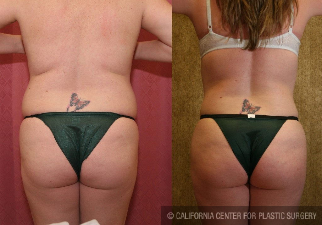 Liposuction Abdomen Medium Before & After Patient #5532