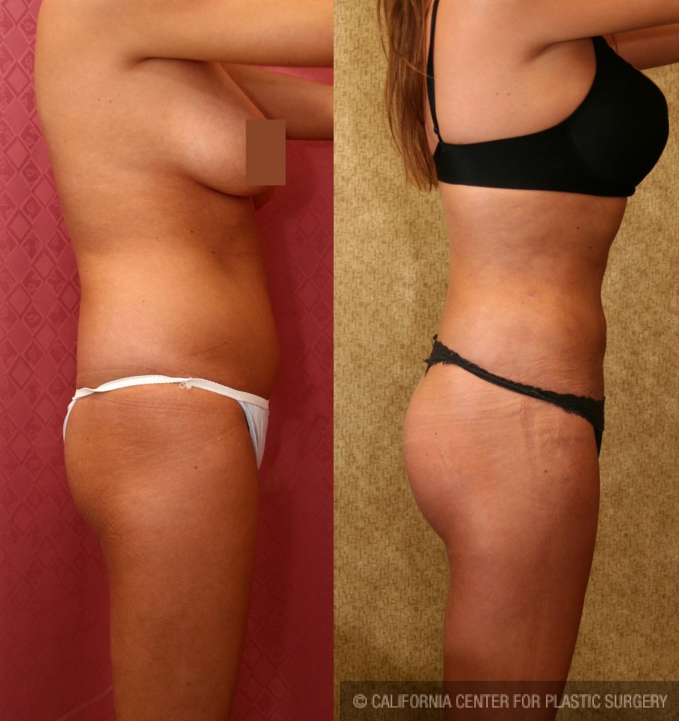 Liposuction Abdomen Medium Before & After Patient #5538