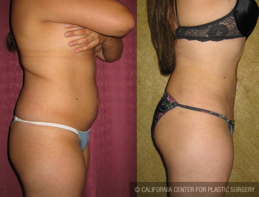 Liposuction Abdomen Medium Before & After Patient #5527