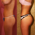 Liposuction Abdomen Medium Before & After Patient #5518