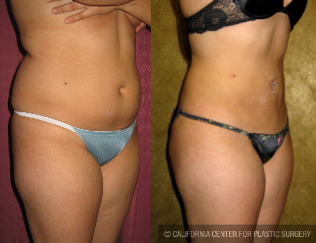 Liposuction Abdomen Medium Before & After Patient #5527