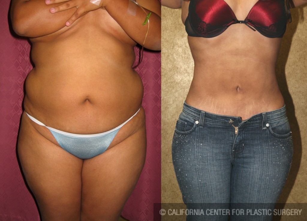 Liposuction Recovery