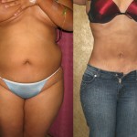 Liposuction Abdomen Medium Before & After Patient #5509