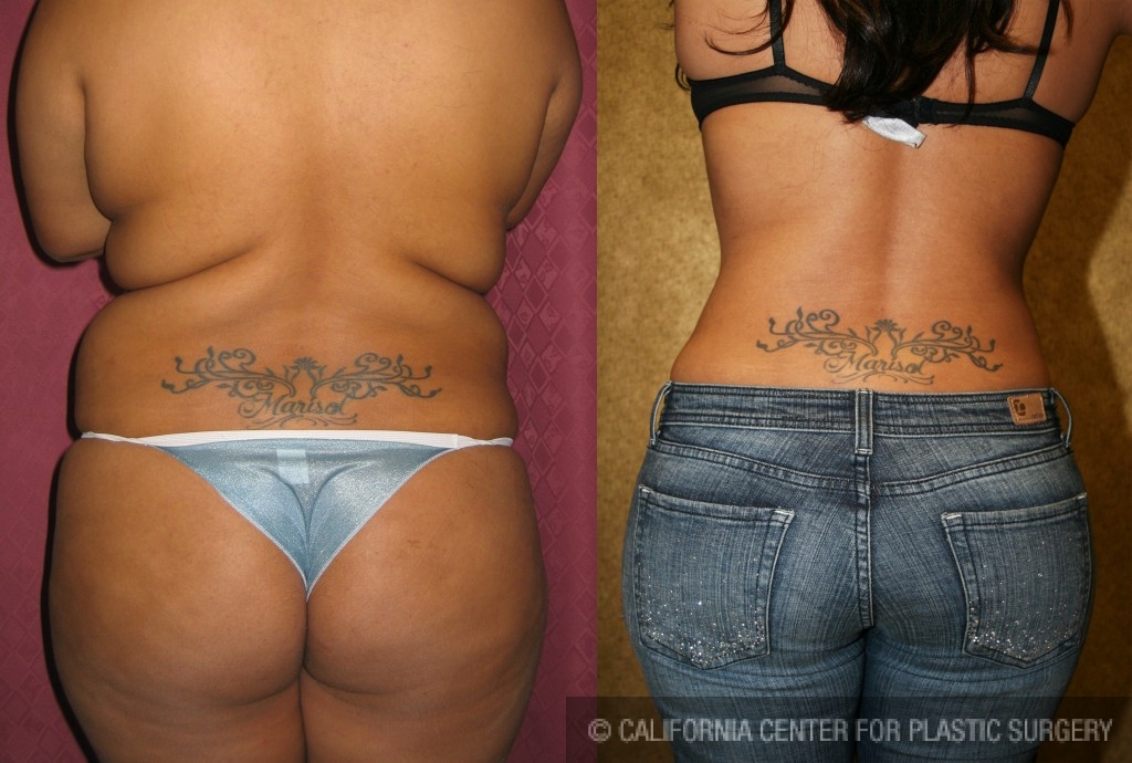 Liposuction Abdomen Medium Before & After Patient #5509