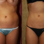 Liposuction Abdomen Medium Before & After Patient #5505