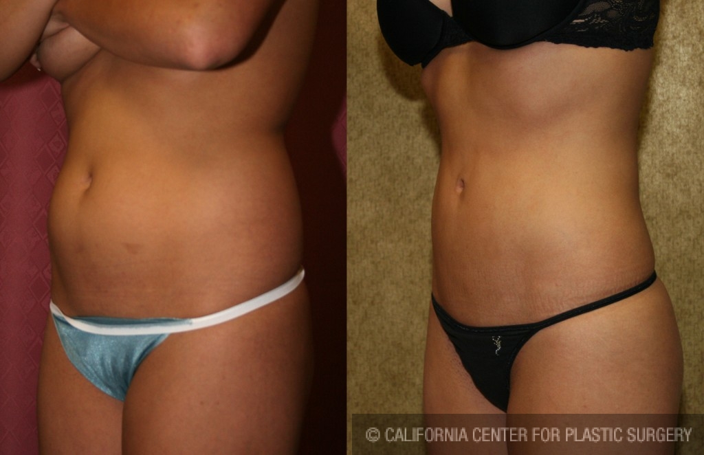 Liposuction Abdomen Medium Before & After Patient #5505