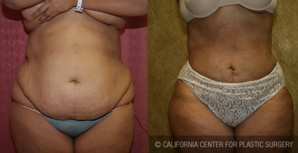 Liposuction Abdomen Plus Size Before & After Patient #5580