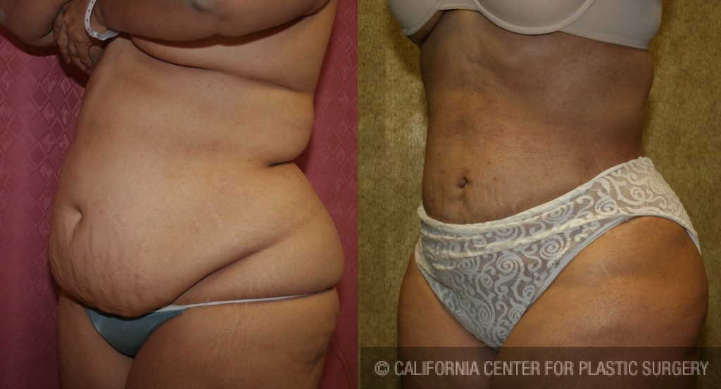 Liposuction Abdomen Plus Size Before & After Patient #5580