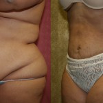 Liposuction Abdomen Plus Size Before & After Patient #5580