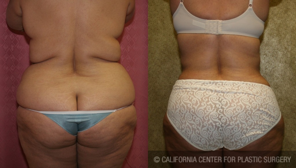 Liposuction Abdomen Plus Size Before & After Patient #5580