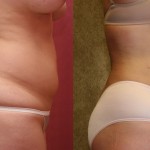 Liposuction Abdomen Medium Before & After Patient #5522