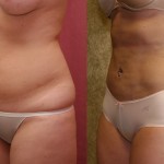 Liposuction Abdomen Medium Before & After Patient #5522