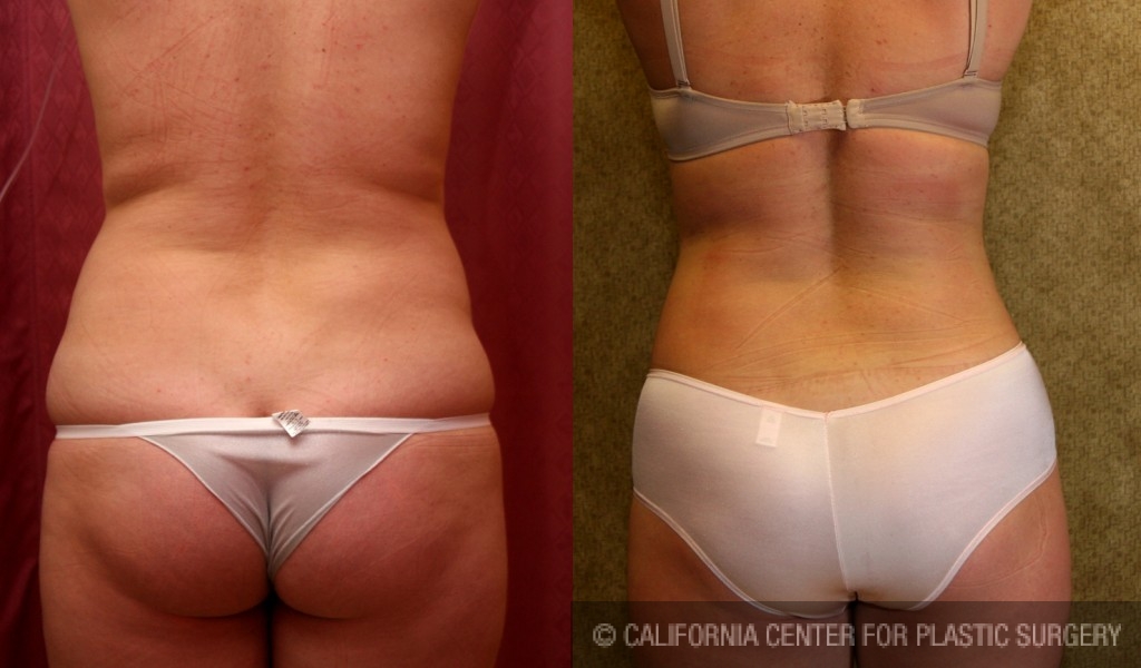 Liposuction Abdomen Medium Before & After Patient #5522