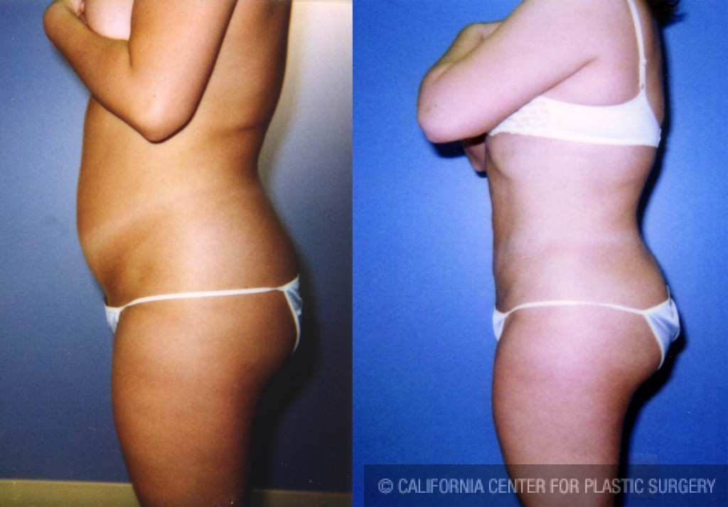 Liposuction Abdomen Medium Before & After Patient #5541