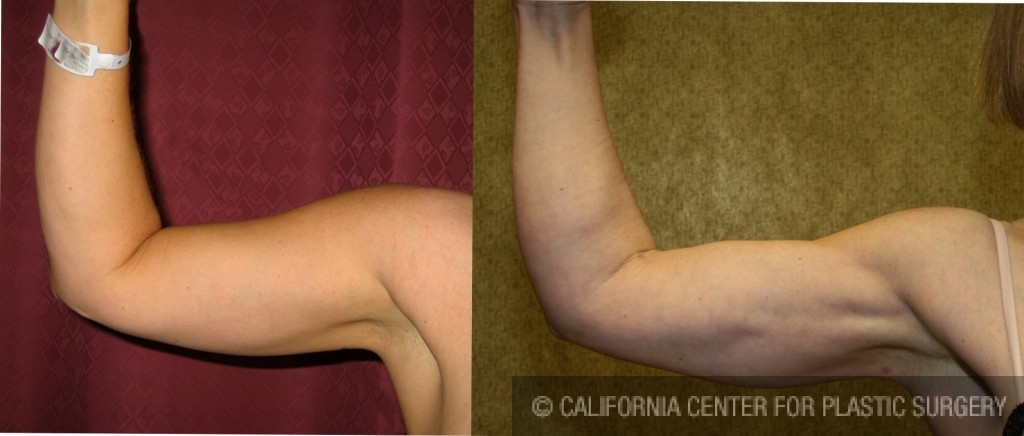Patient #5715 Liposuction Arms Before and After Photos Beverly Hills -  Plastic Surgery Gallery Los Angeles, CA - Dr. Sean Younai, arm lipo  compression garment 