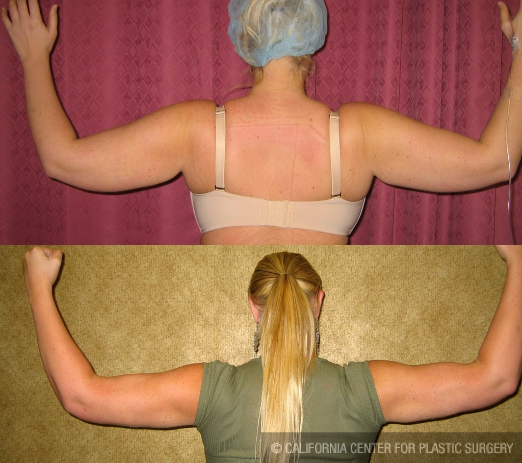Liposuction Arms Before & After Patient #5686