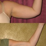 Liposuction Arms Before & After Patient #5686