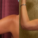 Liposuction Arms Before & After Patient #5695