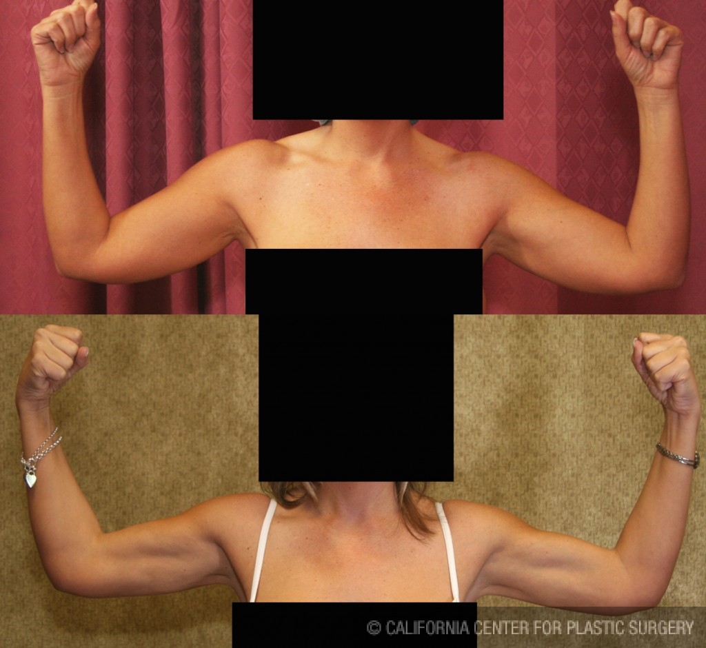 Liposuction Arms Before & After Patient #5695