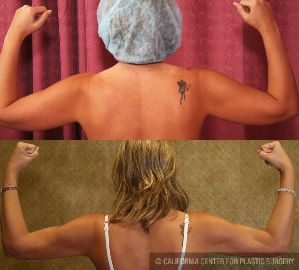 Liposuction Arms Before & After Patient #5695