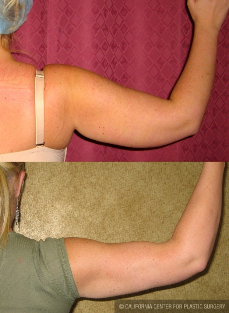 Liposuction Arms Before & After Patient #5686