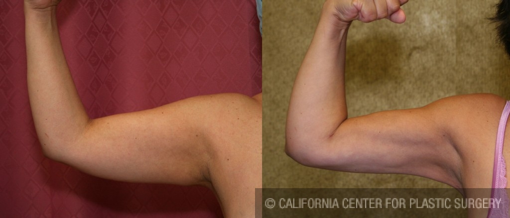 Liposuction Arms Before & After Patient #5704