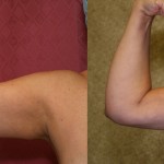 Liposuction Arms Before & After Patient #5704