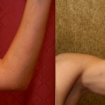 Liposuction Arms Before & After Patient #5690