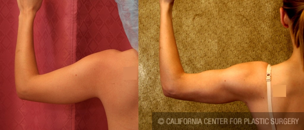 Liposuction Arms Before & After Patient #5690