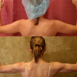 Liposuction Arms Before & After Patient #5690