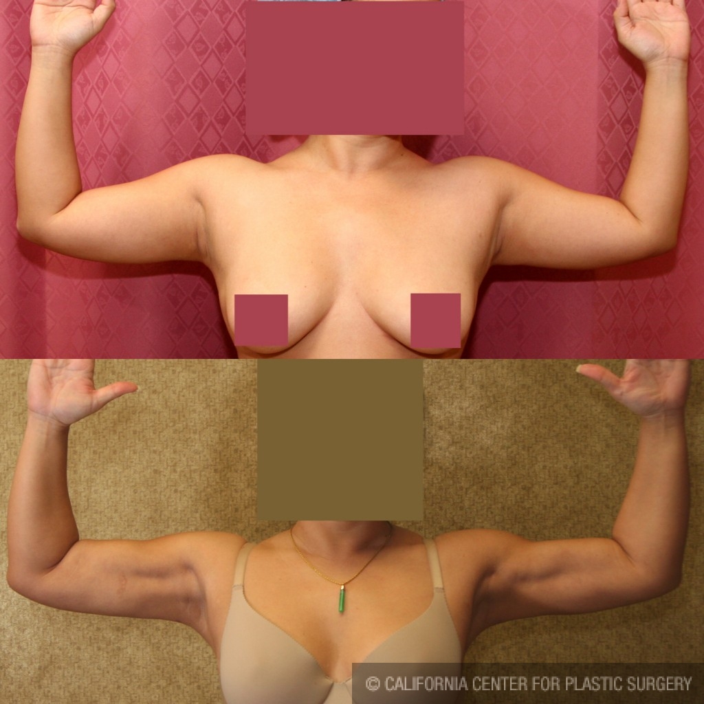 Liposuction Arms Before & After Patient #5712