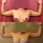 Liposuction Arms Before & After Patient #5712