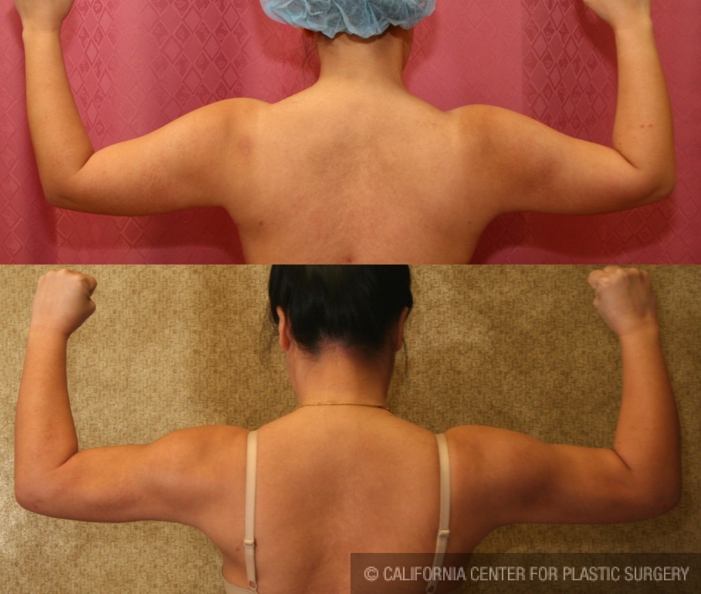 Liposuction Arms Before & After Patient #5712