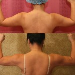 Liposuction Arms Before & After Patient #5712