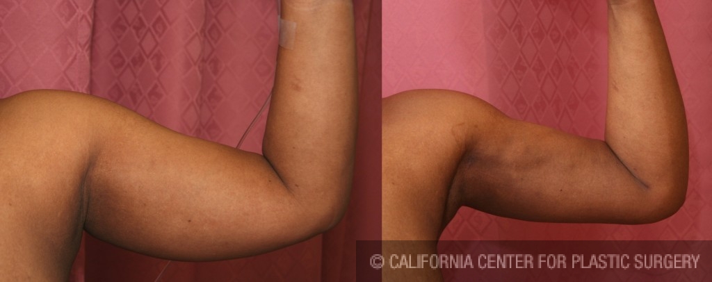 Liposuction Arms Before & After Patient #5715
