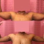 Liposuction Arms Before & After Patient #5715