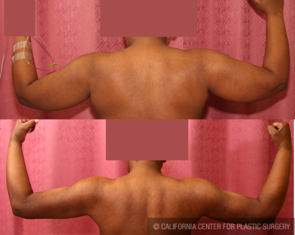 Patient #5715 Liposuction Arms Before and After Photos Beverly