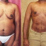 Male Liposuction Abdomen Before & After Patient #5675