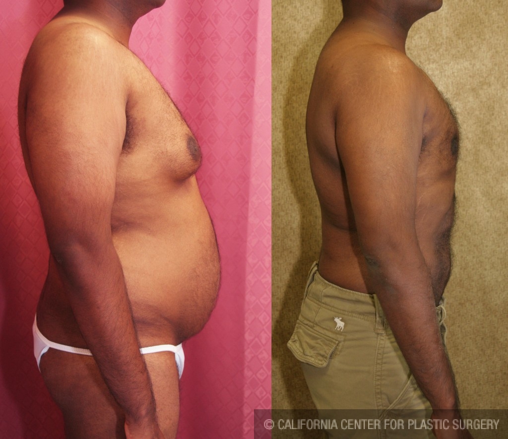 Liposuction - Male Chest Before and After Pictures Case 3