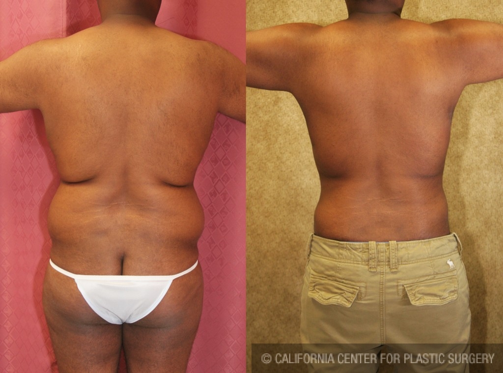 Liposuction Before And After Gallery - MCC Sydney